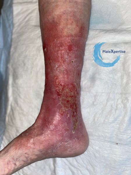Fichier:Eczéma123.jpg