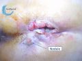 Nodule1.jpg