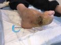 Pied de Charcot25.jpg