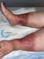 Dermite d'irritation 94.jpg