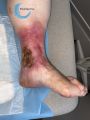 Ulcère veineux19.jpg