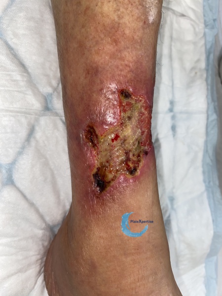 Fichier:Angiodermite typique57.jpg