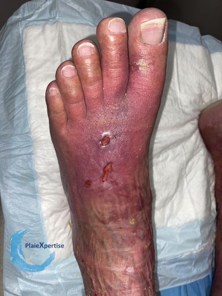 Fichier:Erythrocyanose19.jpg