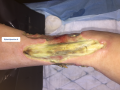 Tendon nécrotique humide13.png