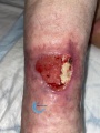 Angiodermite typique55.jpg