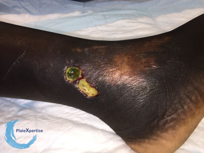 Fichier:Drépanocytose16.jpg