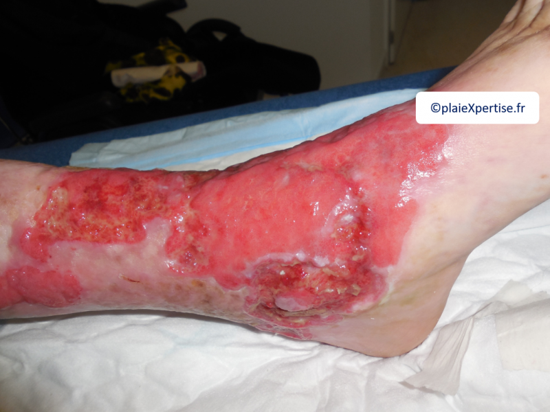Fichier:Erosion en nappe1.png