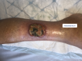 Pyoderma gangrenosum6.png