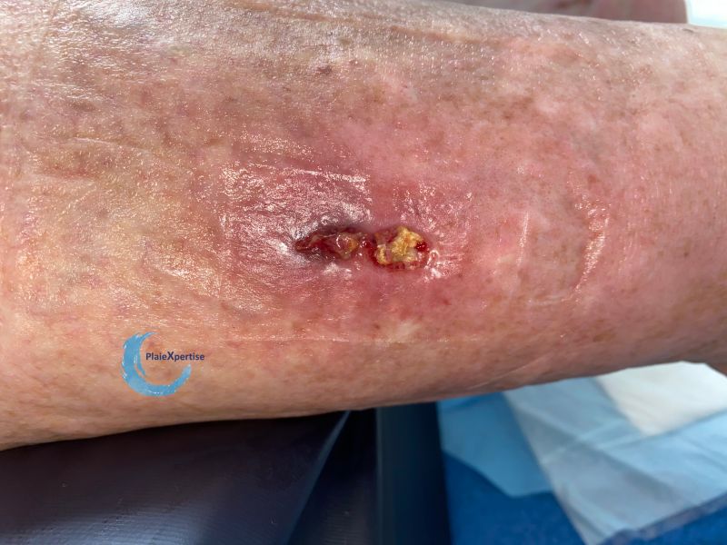 Fichier:Calcifications49.jpg