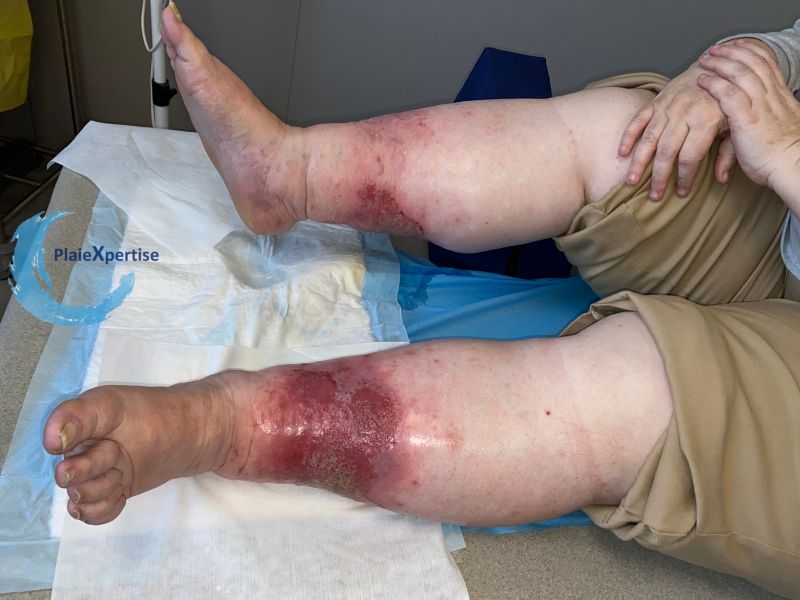 Fichier:Grosses jambes suintantes53.jpg