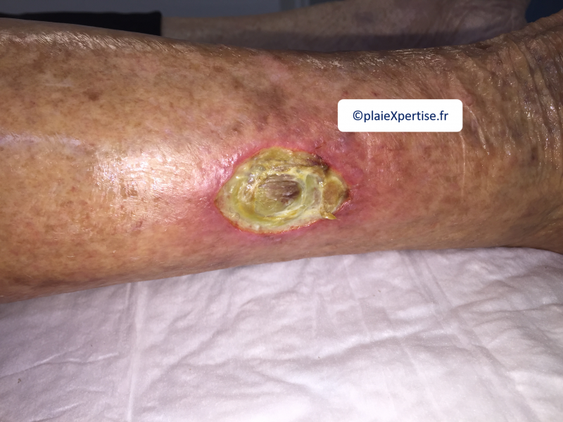 Fichier:Tendon nécrotique humide34.png