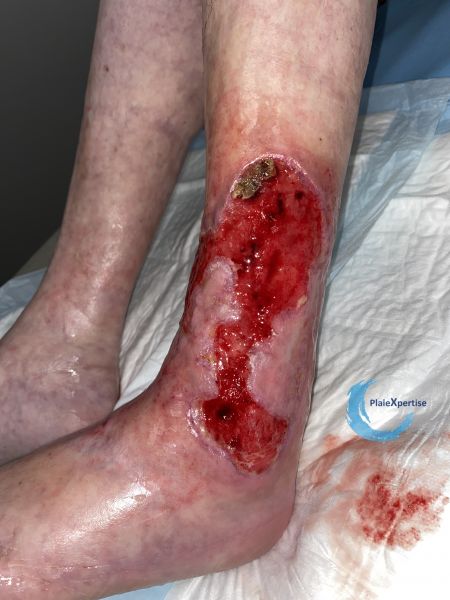 Fichier:Tissu de granulation normal64.jpg