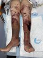 Dermatoporose46.jpg