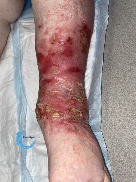 Fichier:Eczéma127.jpg