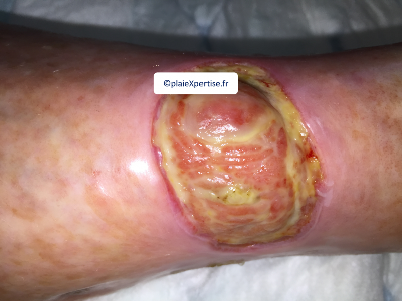 Fichier:Tendon-Voussure1.png