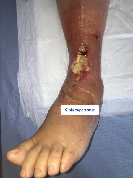 Fichier:Cou de pied16.png