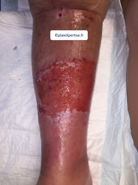 Fichier:Erosion en nappe30.png
