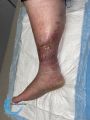 Pyoderma gangrenosum63.jpg