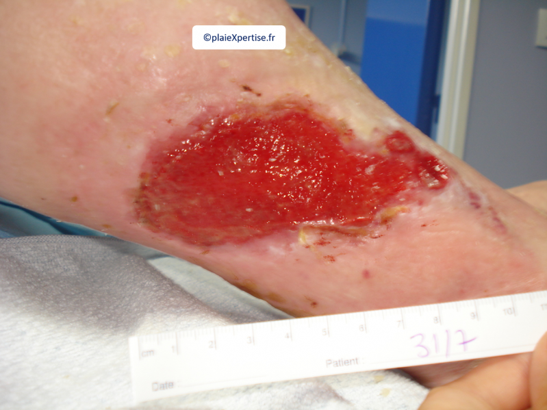 Fichier:Tissu de granulation normal4.png