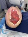 Amputation44.jpg