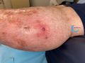 Pustules23.jpg