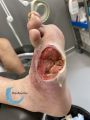 Amputation50.jpg