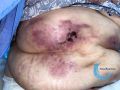 Calciphylaxie11.jpg