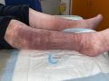 Dermiteocre86.jpg