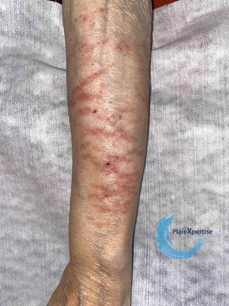 Fichier:Eczéma craquelé31.jpg