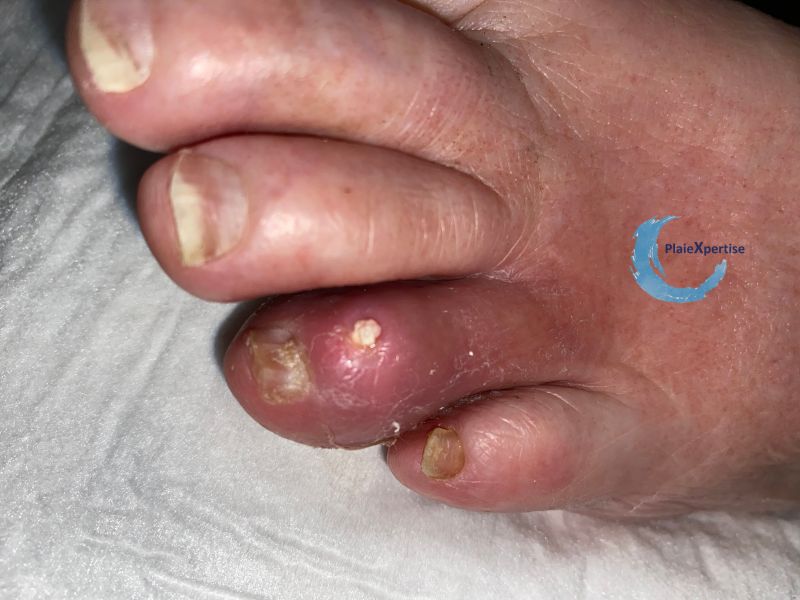 Fichier:Goutte et Tophus20.jpg