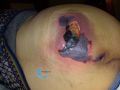 Calciphylaxie19.jpg