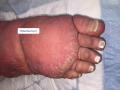 Lymphoedème pied14.png