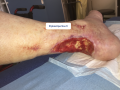Tendon-Reliquat4.png
