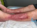Eczéma93.jpg