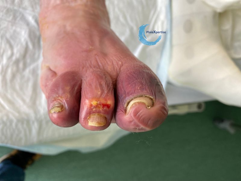 Fichier:Goutte et tophus40.jpg