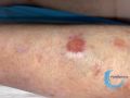 Erosions post bulleuses8.jpg