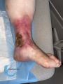 Hypodermite chronique60.jpg