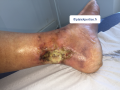 Tendon nécrotique humide19.png