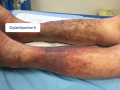 Dermiteocre1.png