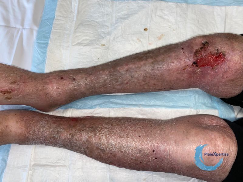 Fichier:Eczéma craquelé25.jpg