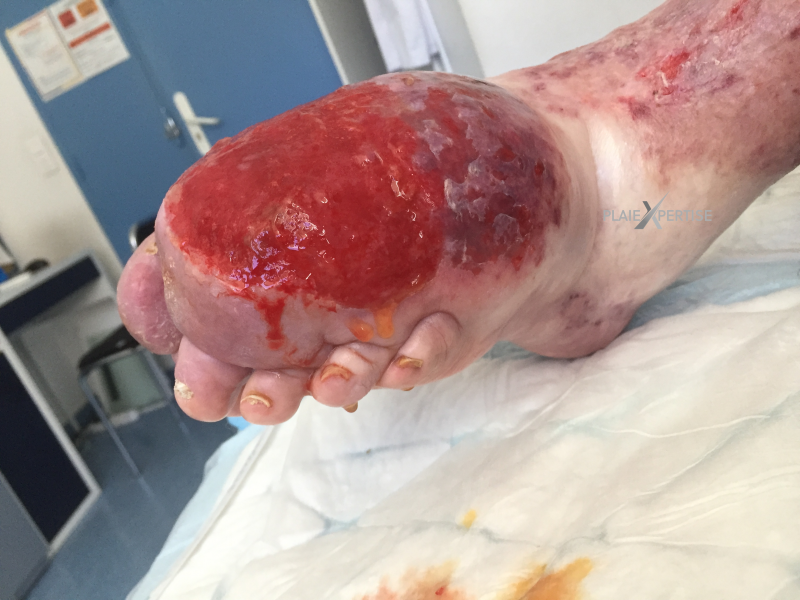 Fichier:Erosion en nappe36.png