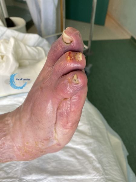 Fichier:Goutte et tophus41.jpg