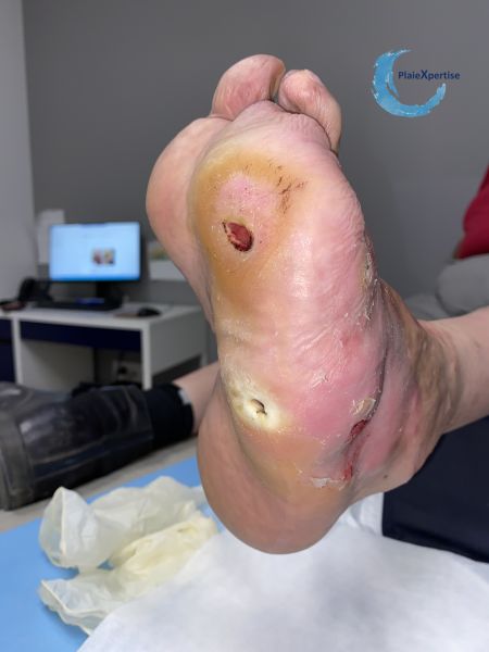 Fichier:Pied de Charcot35.jpg