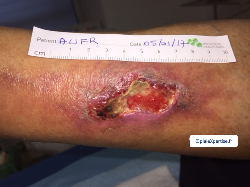 Fichier:Angiodermite typique34.png