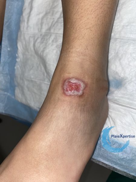 Fichier:Cou de pied72.jpg
