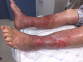 Grosses jambes suintantes16.png