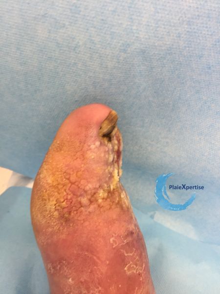 Fichier:Lymphoedème53.jpg