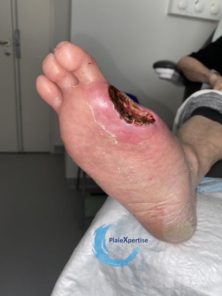 Fichier:Amputation52.jpg