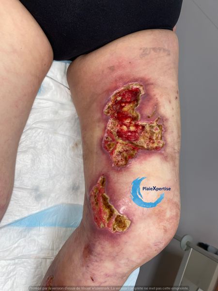 Fichier:Clciphylaxie 25.jpg