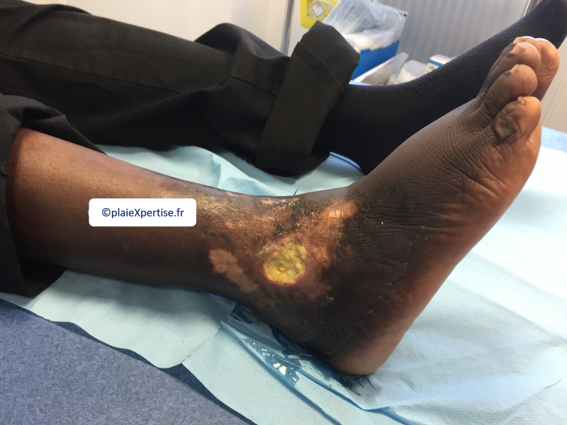 Fichier:Drépanocytose7.png